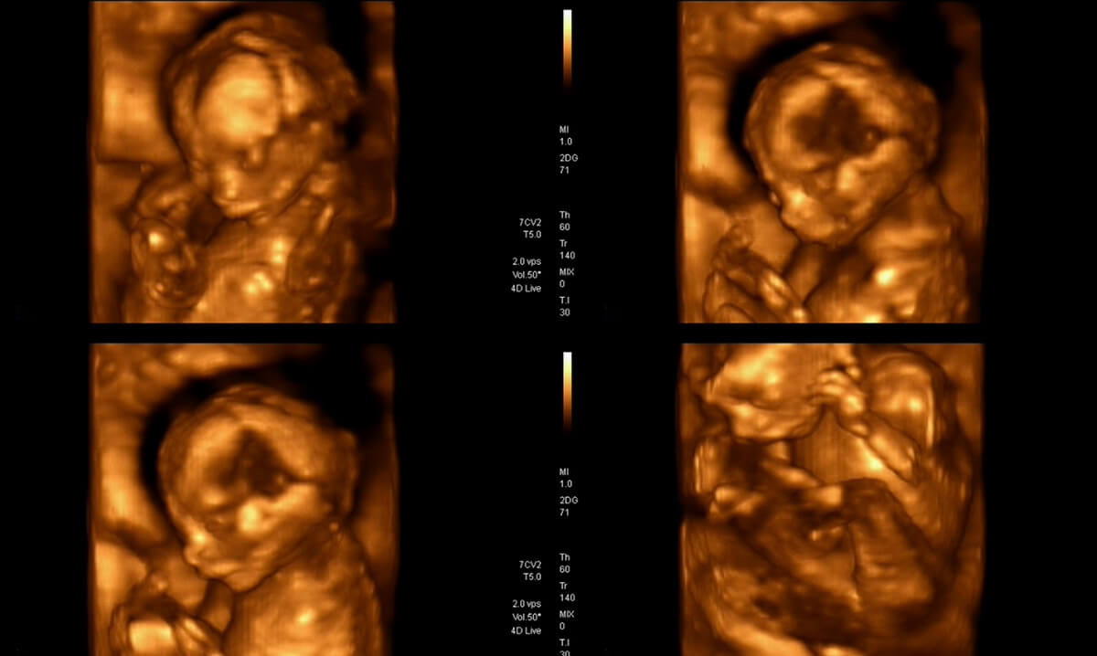 4 boyutlu ultrason