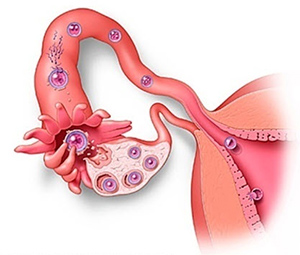 endometriozis komplikasyonları