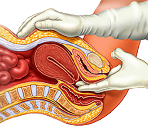 endometriozis tanısı