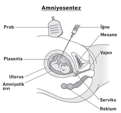 amniyosentez nedir