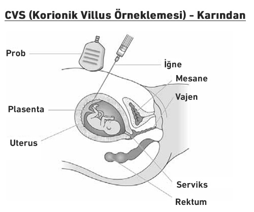 cvs korionik villus - örneklemesi - karından