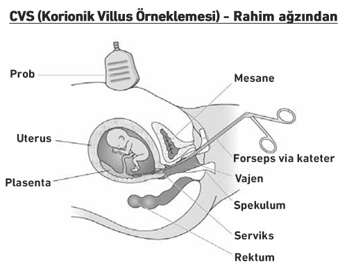 cvs korionik villus - örneklemesi - rahim ağzından