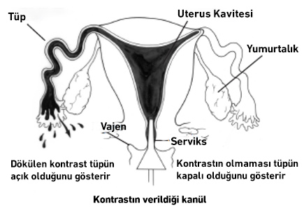 kontrastin-verildigi-kanul