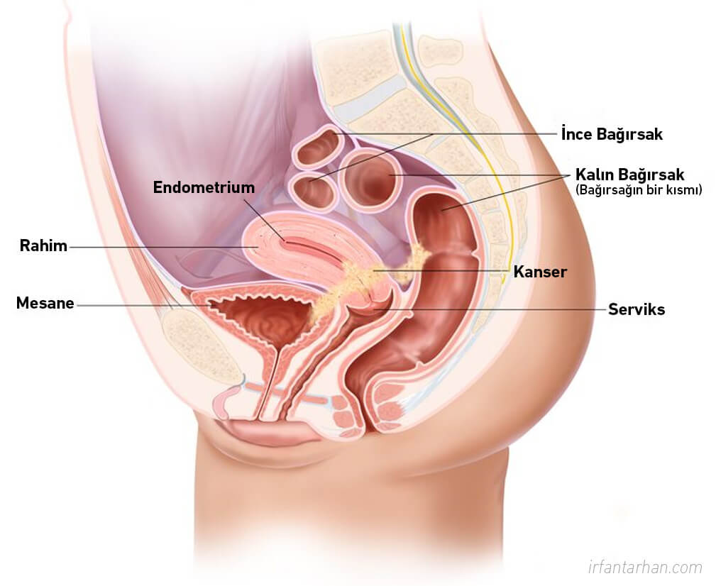 Rahim (Endometrium) Kanseri