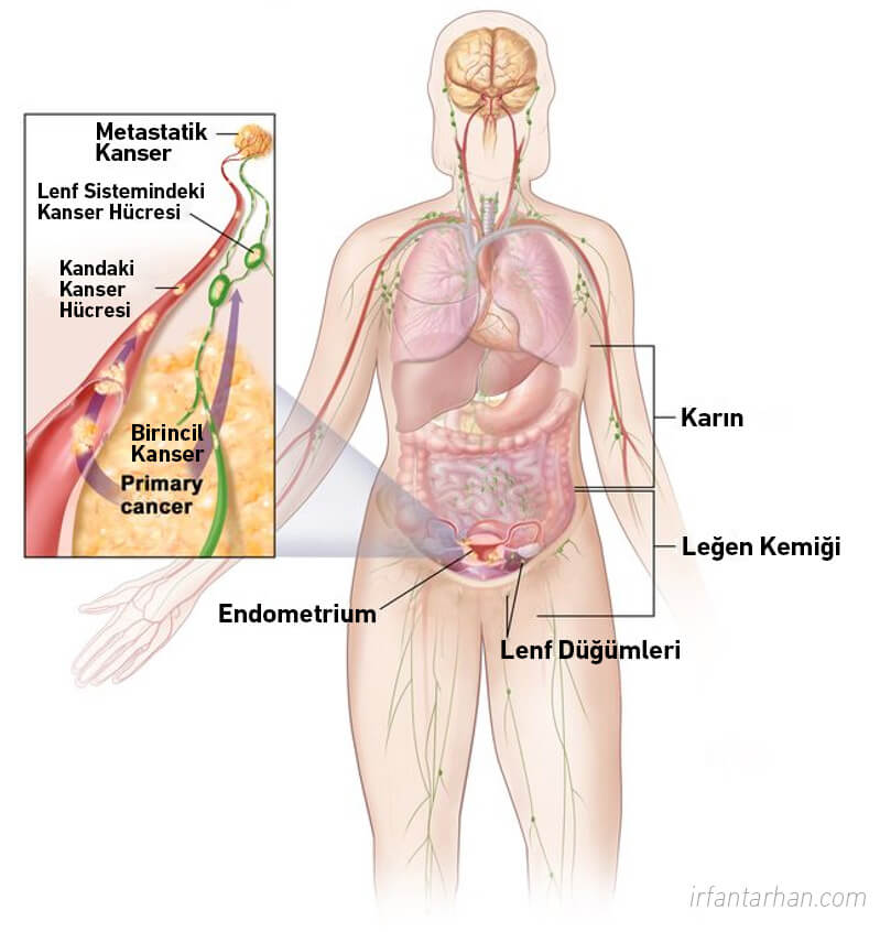 Rahim (Endometrium) Kanseri