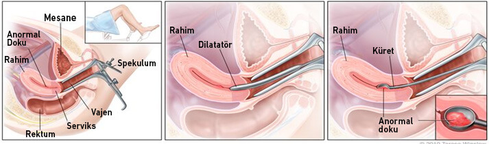 Rahim (Endometrium) Kanseri