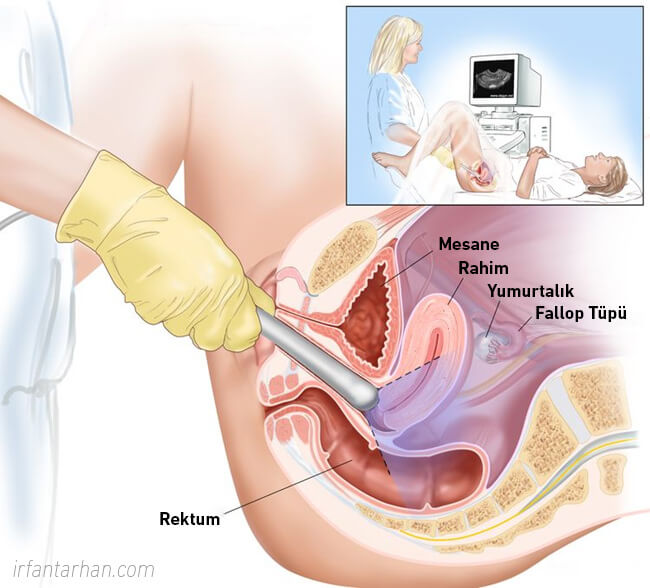 Rahim (Endometrium) Kanseri