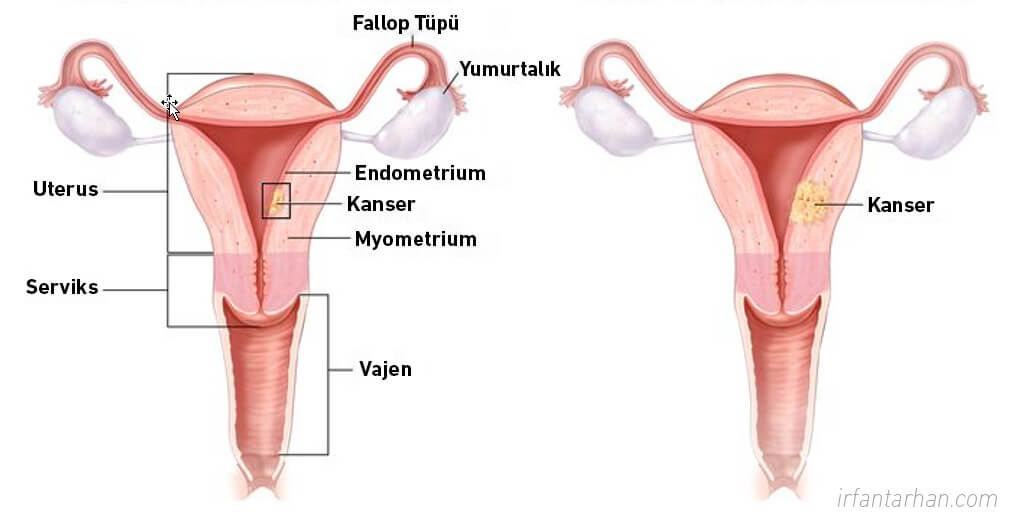 Rahim (Endometrium) Kanseri