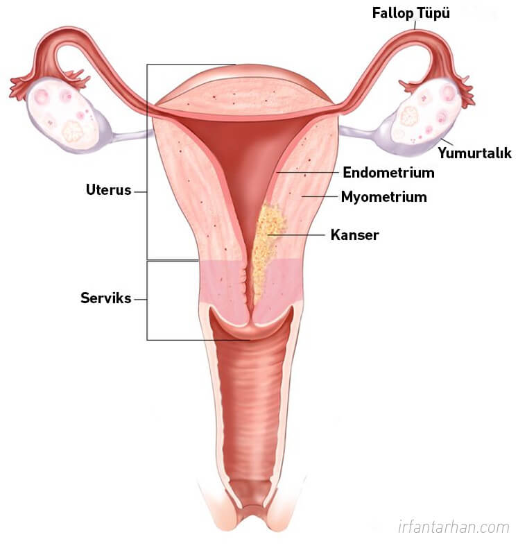 Rahim (Endometrium) Kanseri