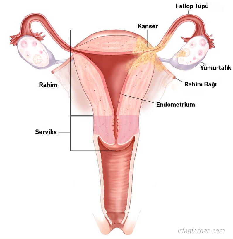 Rahim (Endometrium) Kanseri