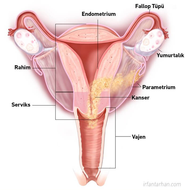Rahim (Endometrium) Kanseri
