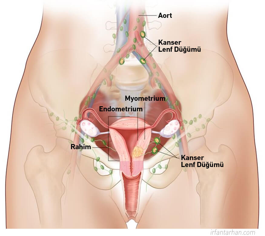 Rahim (Endometrium) Kanseri