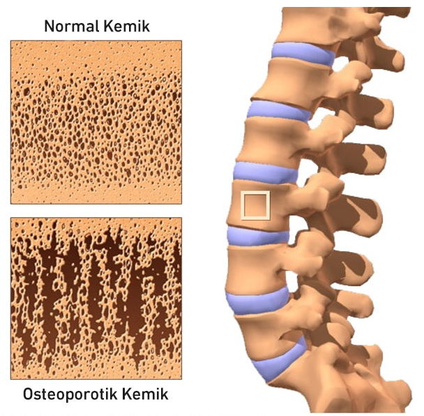 osteoporotik kemik