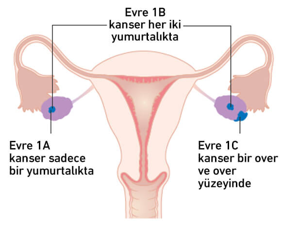 over kanser dereceleri