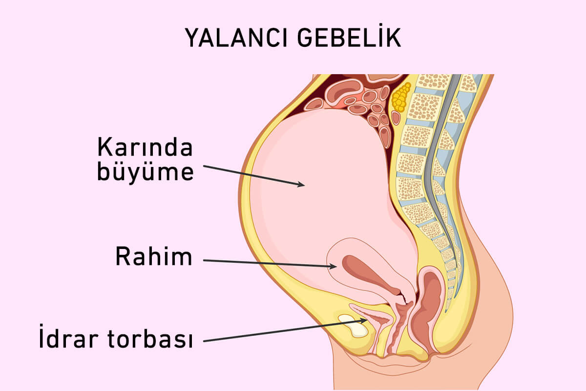 Yalancı gebelik