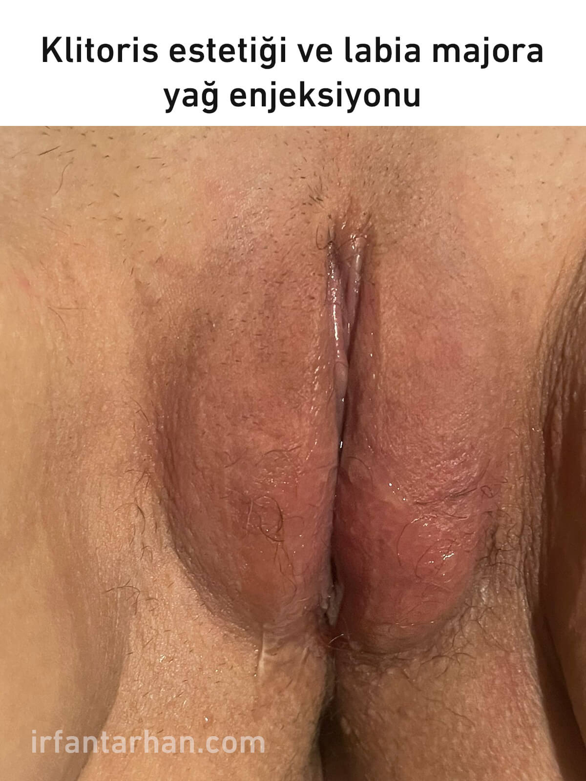 klitoris estetiği
