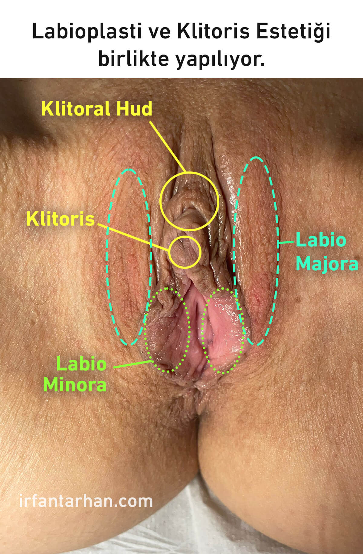 Klitoris Estetiği