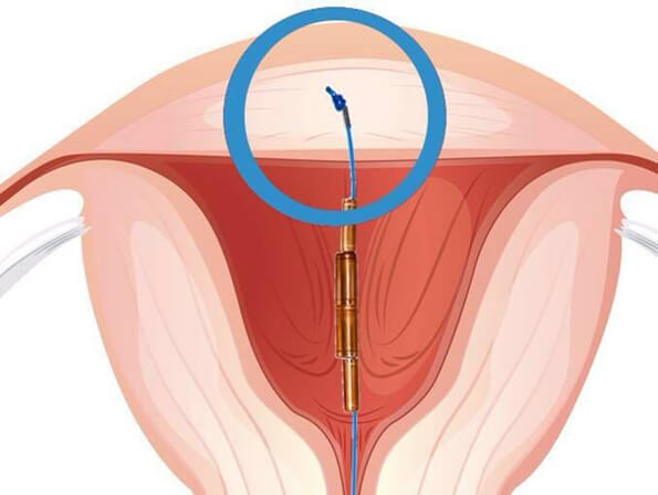 Gynefix Spiral