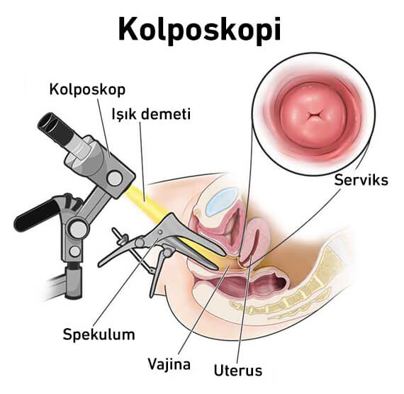 Kolposkopi